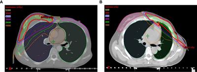 Radiotherapy dosimetry and radiotherapy related complications of immediate implant-based reconstruction after breast cancer surgery